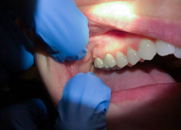 Best Dentist for Tooth Abscess  in Grandview, TX